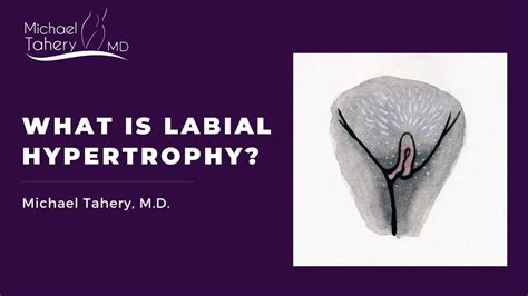 large labial folds|Labia Minora Hypertrophy: Causes, Symptoms, and Treatment .